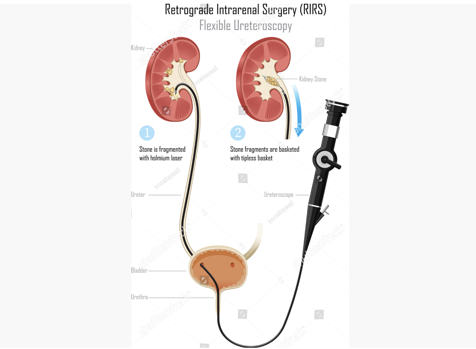 retrograde intrarenal surgery, rirs, flexible ureteroscopy, ureteroscope, human kidney, kidney stone, stone treatments, nephron, break stone, holmium laser, bladder, surgery, endoscopy, ureter, urinary system, dialysis, illness, failure, medical exam, medical procedure, pain, removing, surgical equipment, nephritic, stone - object, medulla, urethra, urology, urinary tract, filtration, diagram, medical illustration, health, physical, healthcare, body, biology, scientific, cross-section, internal organ, anatomical, health care, human, illustration, stock illustration, isolated, royalty free illustrations