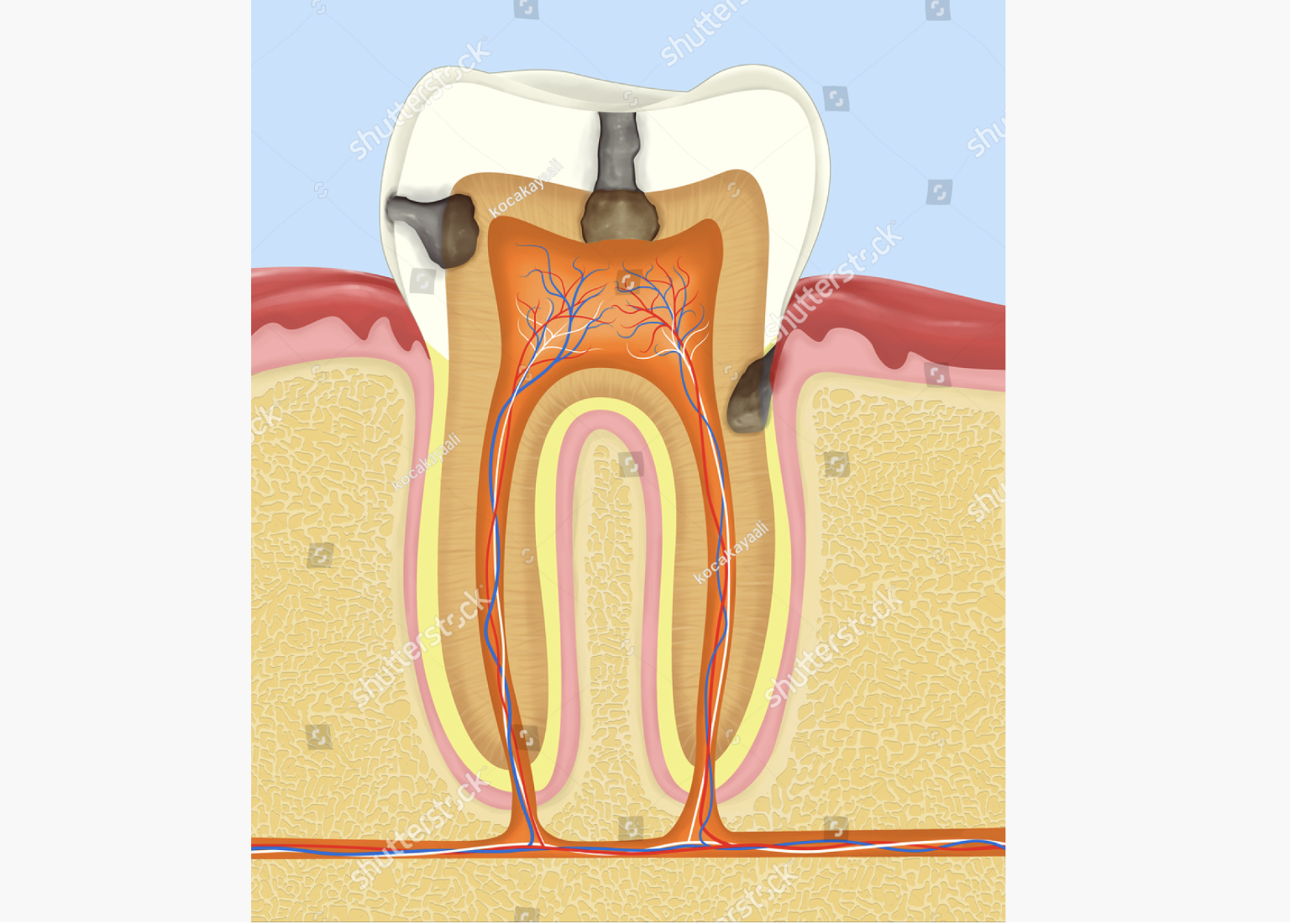 dental caries, carious tooth, rotten tooth, tooth anatomy, dental structure, tooth cross section, tooth cutaway diagram, tooth cross-section artwork, anatomy dental, dental illustration, dentistry, teeth, dentine, tooth internal structure, dental diagram, tooth anatomy drawing, dental cross section, tooth nerves, root canal, periodontal, tooth blood vessels, dental root anatomy, dental illustration artwork, tooth anatomy artwork, dental artwork, tooth structure illustration, dental cross-sectional view, tooth anatomy diagram, tooth anatomy illustration, dental illustration design, dental cutaway drawing