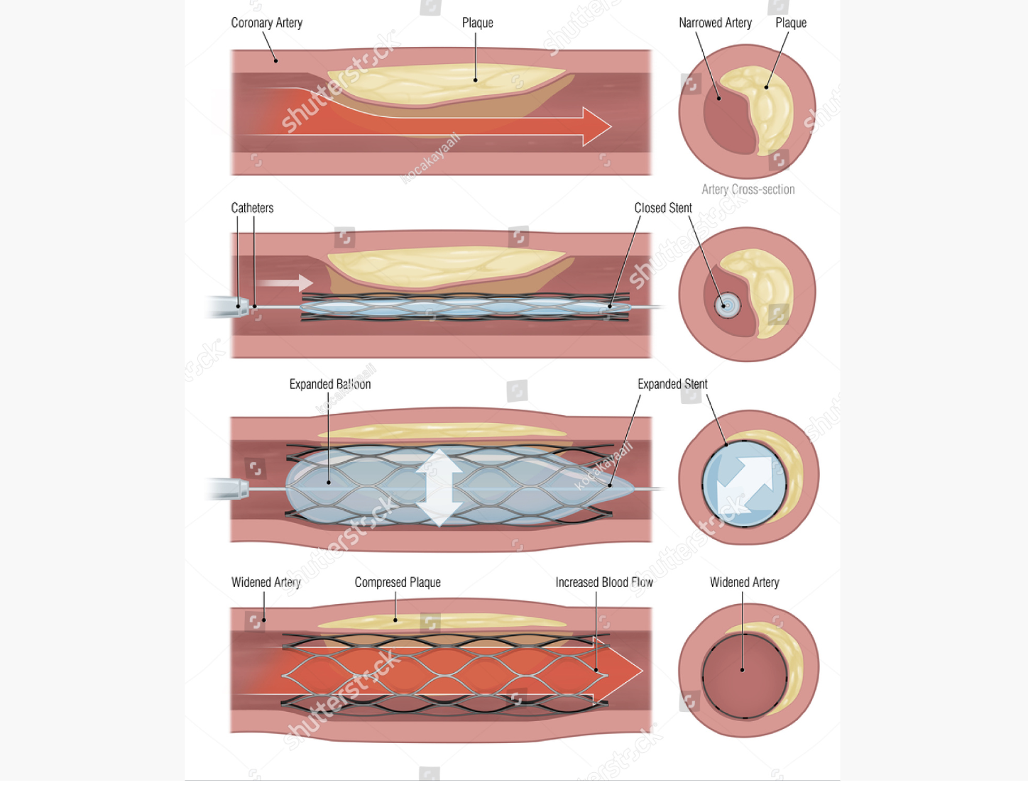 stent, angio, angioplasty, coronary, arterial blockage by fatty plaque, balloon inflation in narrowed vessel, stent deployment in angiogram, coronary artery intervention, medical device illustration, cardiac balloon, cardiovascular surgery visualization, interventional cardiology artwork, stent implantation graphic, artery treatment illustration, cardiac catheterization illustration, open heart surgery, cardiovascular intervention procedure, medical stent placement illustration, artery dilation with stent, coronary artery disease treatment, medical illustration of vascular procedure, stent insertion in blocked artery, angiography with stent placement, artery reopening with stent, cardiac artery intervention illustration