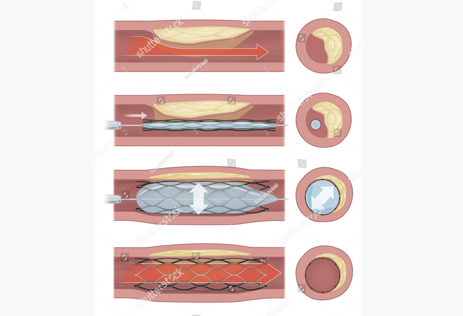 Medical illustration diagram showing the process of coronary angioplasty with balloon expansion and stent placement to restore blood flow in a narrowed artery.