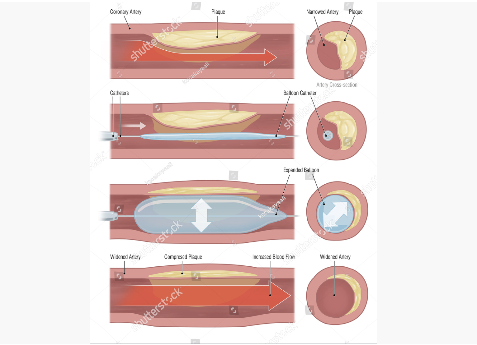 coronary, artery, balloon, arterial blockage by fatty plaque, balloon inflation in narrowed vessel, stent deployment in angiogram, coronary artery intervention, angioplasty, medical device illustration, cardiac balloon, cardiovascular surgery visualization, interventional cardiology artwork, stent implantation graphic, artery treatment illustration, cardiac catheterization illustration, open heart surgery, cardiovascular intervention procedure, medical stent placement illustration, artery dilation with stent, coronary artery disease treatment, medical illustration of vascular procedure, stent insertion in blocked artery, angiography with stent placement, artery reopening with stent, cardiac artery intervention illustration