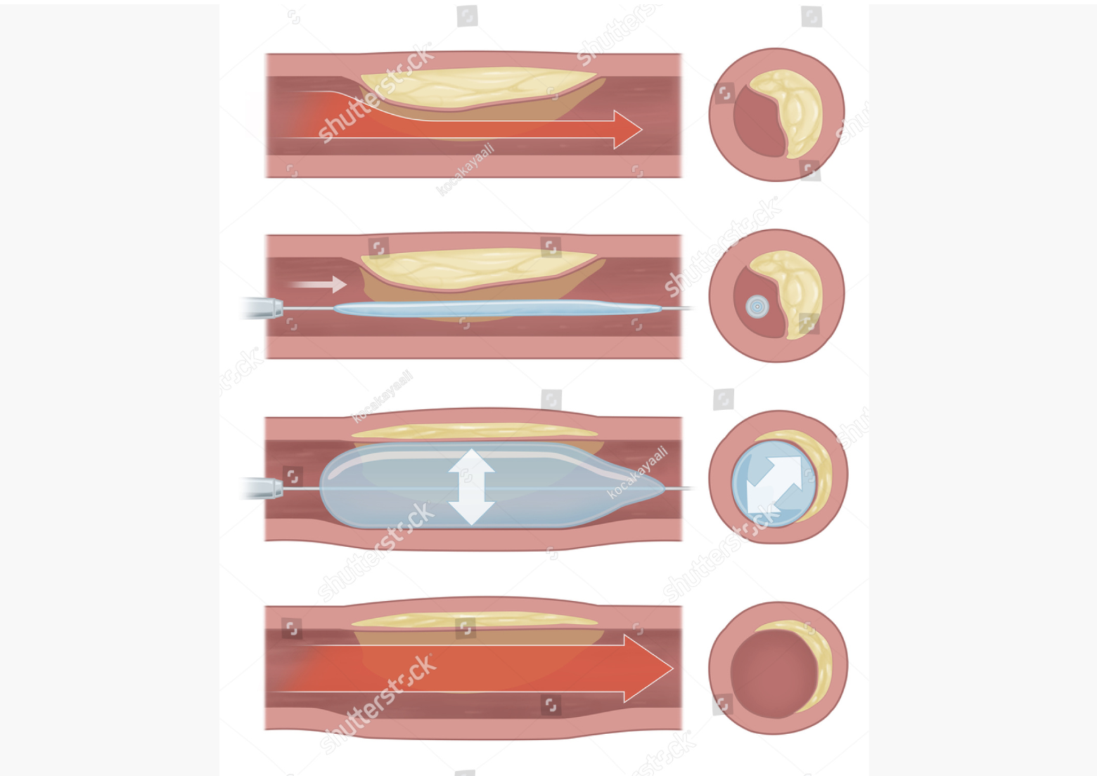 coronary, artery, balloon, arterial blockage by fatty plaque, balloon inflation in narrowed vessel, stent deployment in angiogram, coronary artery intervention, angioplasty, medical device illustration, cardiac balloon, cardiovascular surgery visualization, interventional cardiology artwork, stent implantation graphic, artery treatment illustration, cardiac catheterization illustration, open heart surgery, cardiovascular intervention procedure, medical stent placement illustration, artery dilation with stent, coronary artery disease treatment, medical illustration of vascular procedure, stent insertion in blocked artery, angiography with stent placement, artery reopening with stent, cardiac artery intervention illustration